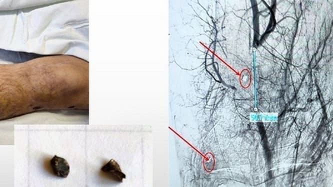 Нижегородские ученые исследуют влияние осколков на организм раненых