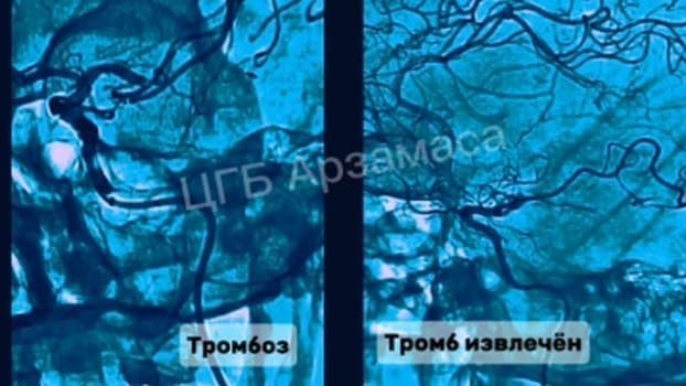 Нижегородские врачи спасли мозг пациента от тромбоза
