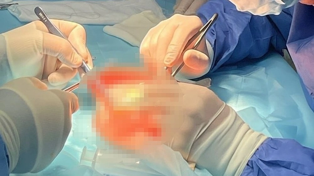 В Нижнем Новгороде провели вторую за год операцию по пересадке почки