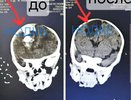 Нижегородские врачи спасли от смерти младенца с кровоизлиянием в мозг