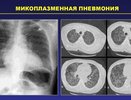 Пневмотест на микроплазменную инфекцию запущен в Нижнем Новгороде