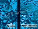 Нижегородские врачи спасли мозг пациента от тромбоза