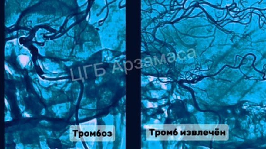 Главная картинка новости: Нижегородские врачи спасли мозг пациента от тромбоза